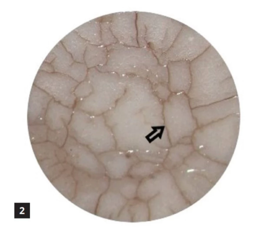 Harvard Ionoresin Fill v kyselém pH po 14 dnech <br>
Fig. 2 Harvard Ionoresin Fill at acidic pH after 14 days
