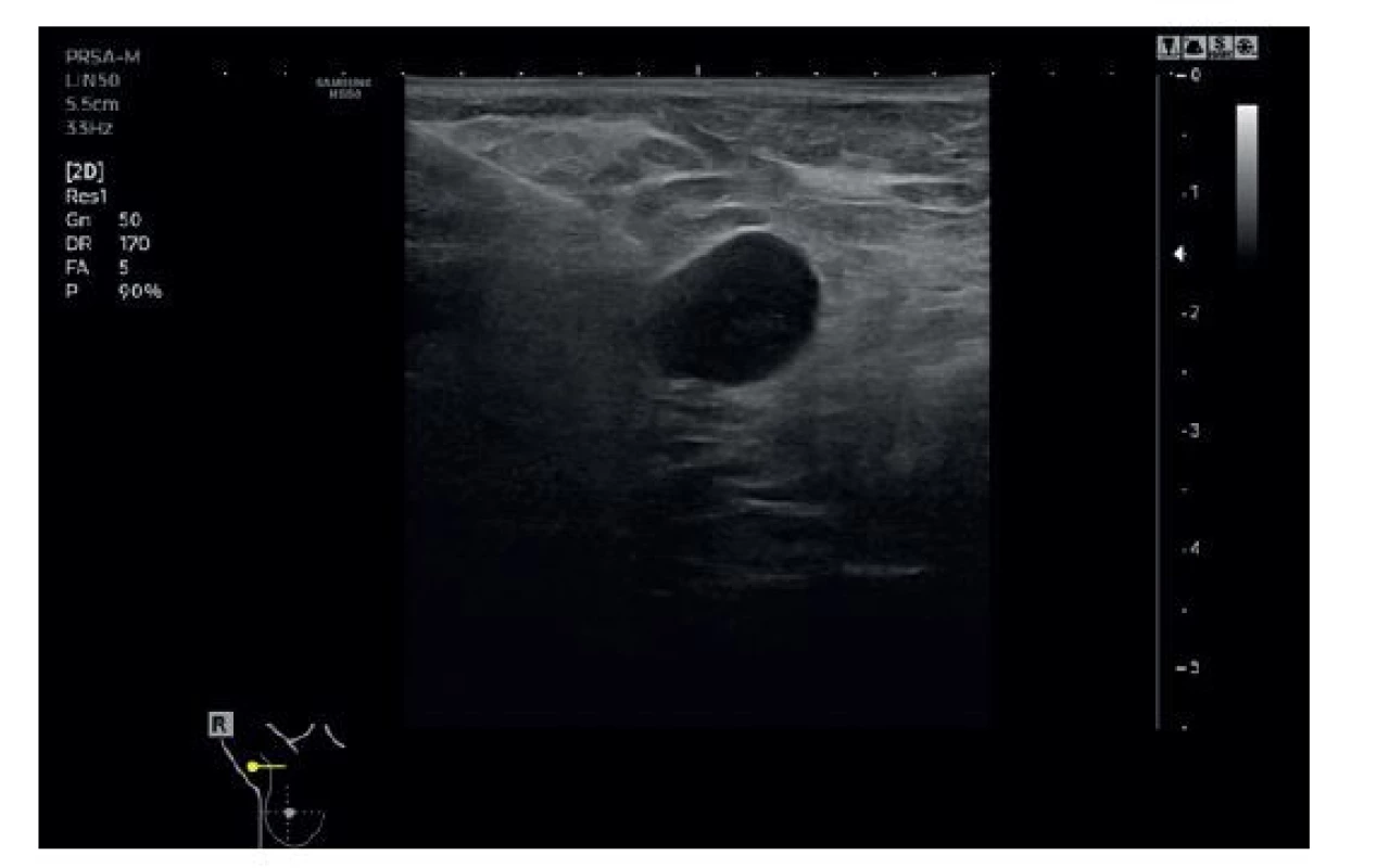 Core cut biopsie z jedné z axilárních LU 7. 12. 2020,
bioptická jehla před nodulárně rozšířeným kortexem
zvětšené LU<br>
Fig. 3: Core needle biopsy of one of the axillary lymph nodes
of 7. 12. 2020, biopsy needle in front of the enlarged
node with cortical thickening