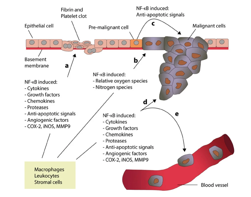 The role of NF-kappaB in the inflammatory process and in the case of inflammation associated with carcinoma (modified according to Zhang et 
al. (24) – created in collaboration with Service Center for E-Learning at Masaryk University, Faculty of Informatics). A – Leukocytes and stromal cells secrete 
an abundance of proinflammatory proteins during inflammation. B – Proinflammatory factors in the microenvironment of latent pre-malignant cells 
lead to the accumulation of DNA damage, which, in turn, causes these cells to become malignant. C – Activation of NF-kappaB in pre-malignant cells 
induces anti-apoptotic signals, which prevents apoptosis and enhances their proliferation. D and E – Leukocytes and stromal cells secret proinflammatory 
proteins in their chronically inflamed microenvironment, which stimulates tumor progression and metastasis