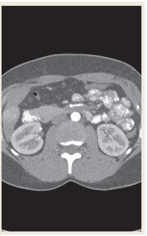 CT angiografie břicha (snímky použity s dovolením
ZRIR IKEM).<br>
Fig. 3. Abdominal CT angiography (images used with permission
from ZRIR IKEM).