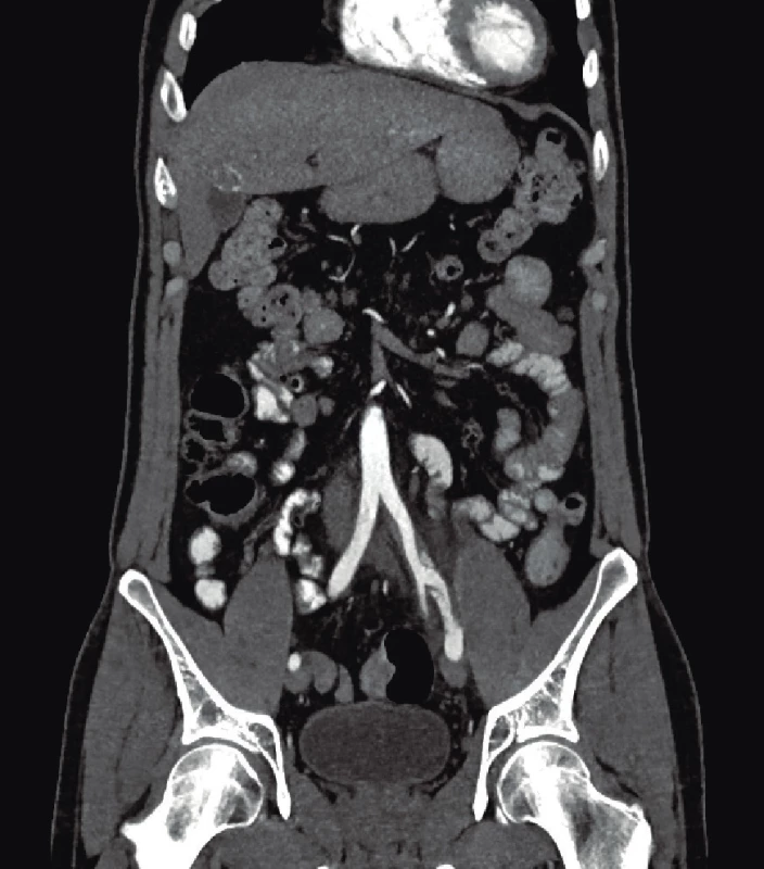 CT angiografie, koronární rekonstrukce disekované
společné až vnější ilické tepny vlevo