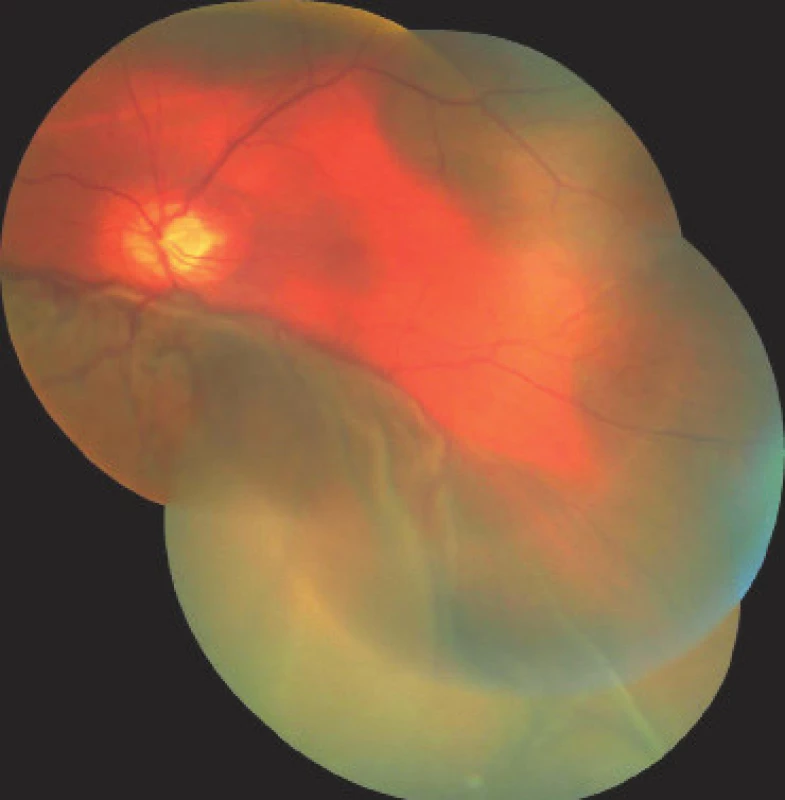 Photograph of fundus of left eye on 1st day after
surgical revision of LE