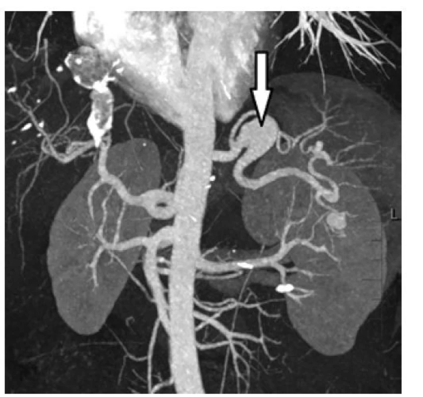 CT-AG po operaci výdutě slezinné tepny<br>
Fig. 3: Splenic artery aneurysm repair (CT-AG)