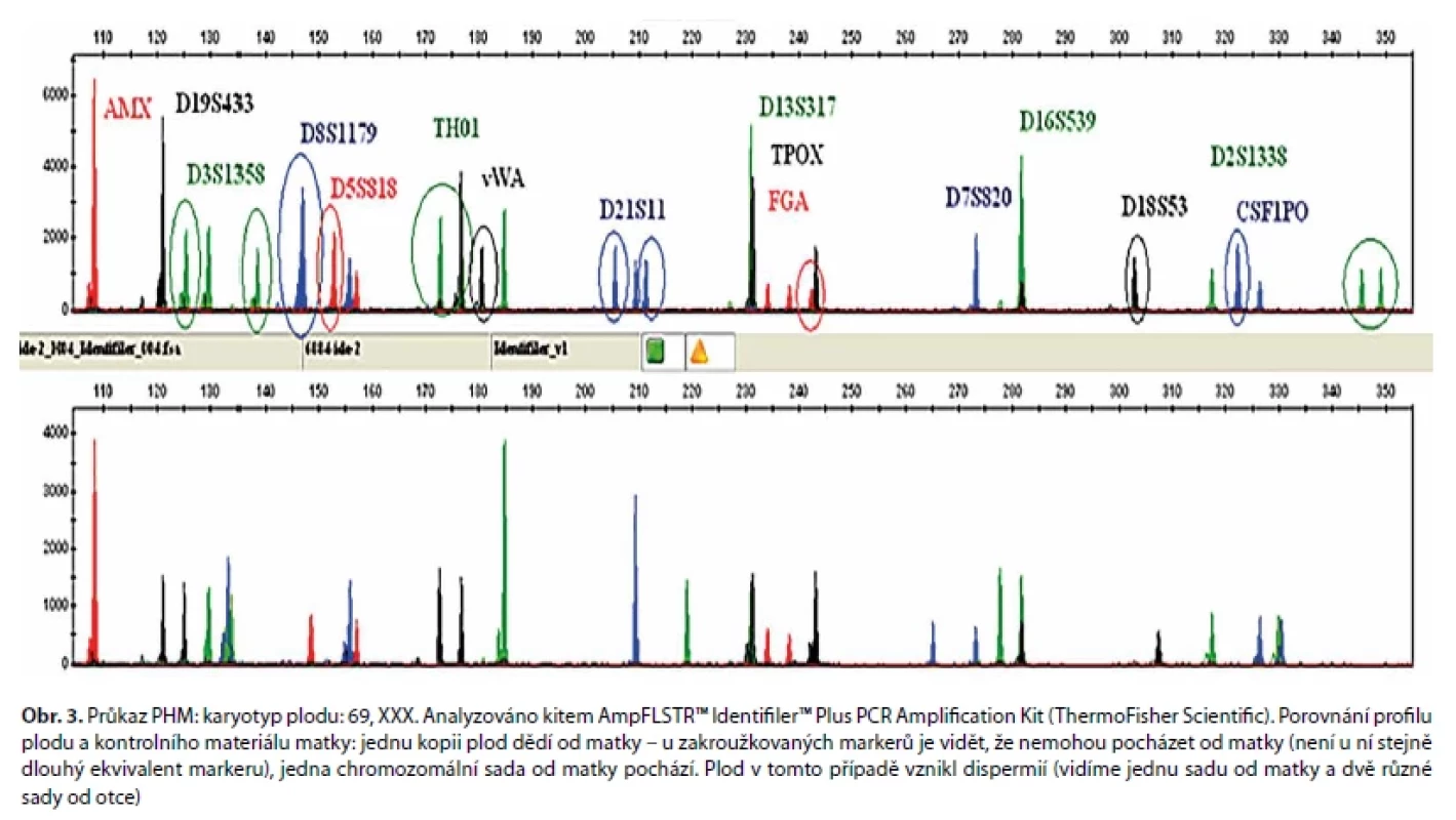 Průkaz PHM: karyotyp plodu: 69, XXX. Analyzováno kitem AmpFLSTR™ Identifiler™ Plus PCR Amplification Kit (ThermoFisher Scientific). Porovnání profilu
plodu a kontrolního materiálu matky: jednu kopii plod dědí od matky – u zakroužkovaných markerů je vidět, že nemohou pocházet od matky (není u ní stejně
dlouhý ekvivalent markeru), jedna chromozomální sada od matky pochází. Plod v tomto případě vznikl dispermií (vidíme jednu sadu od matky a dvě různé
sady od otce)