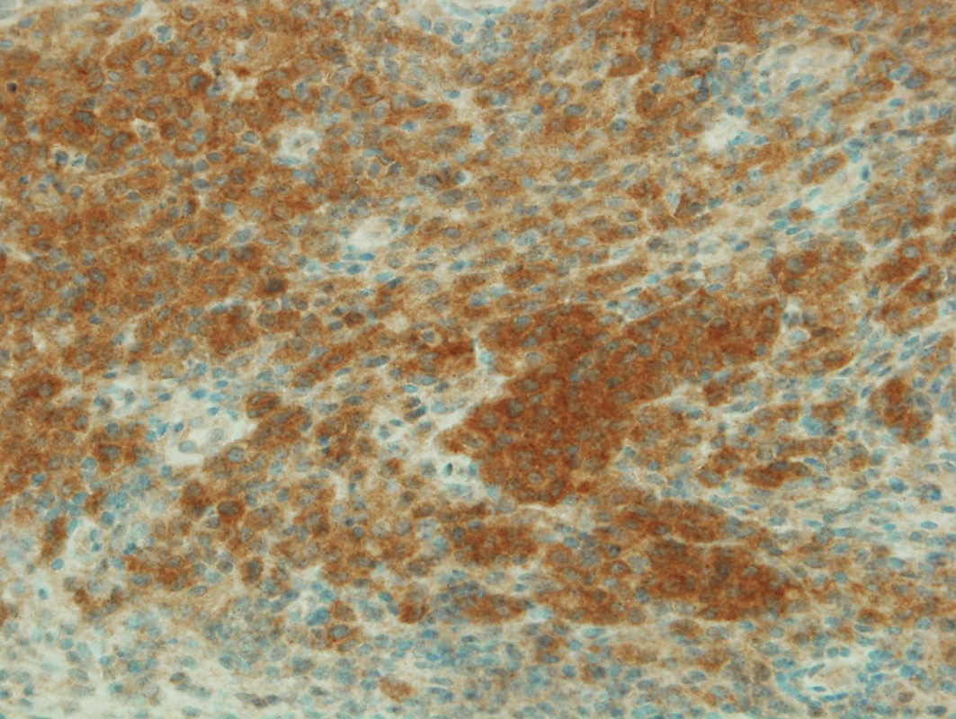 Pozitivní mutace BRAF V600E imunohistochemicky (400x)<br>
Pacient je léčen BRAF inhibitorem s výborným výsledkem.
