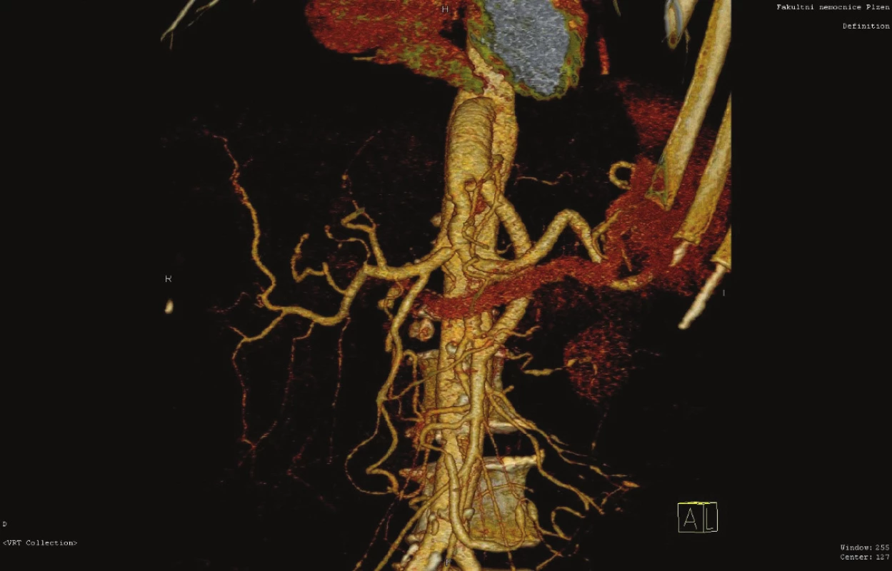 Antegrádní aorto-mezenterický/trunkální protetický
bypass (CT AG)<br>
Fig. 9: Antegrade aorto-mesenteric/trunk bypass (artificial
graft) (CT AG)