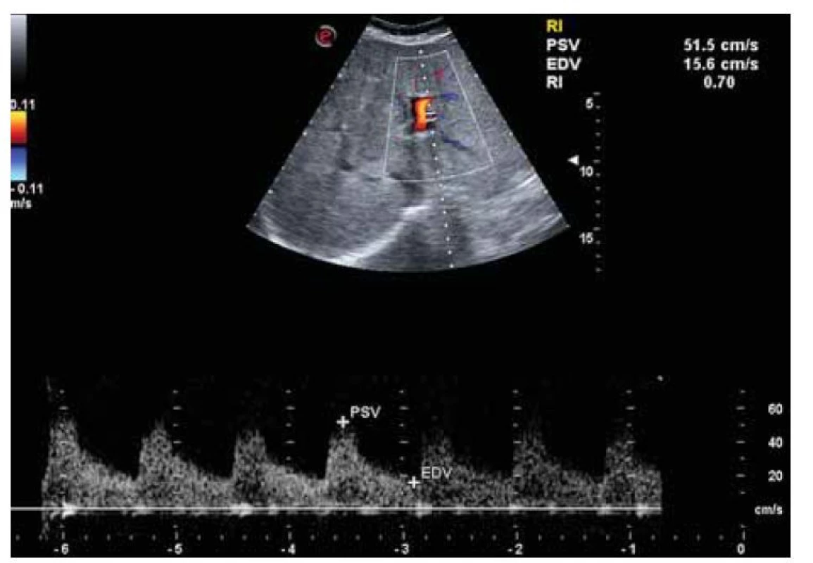 USG nález zvýšeného indexu rezistencie na arteria hepatica svedčiaci
pre chronickú hepatopatiu.<br>
Fig. 3. USG finding of increased resistance index in the hepatic artery characteristic
for chronic hepatopathy.