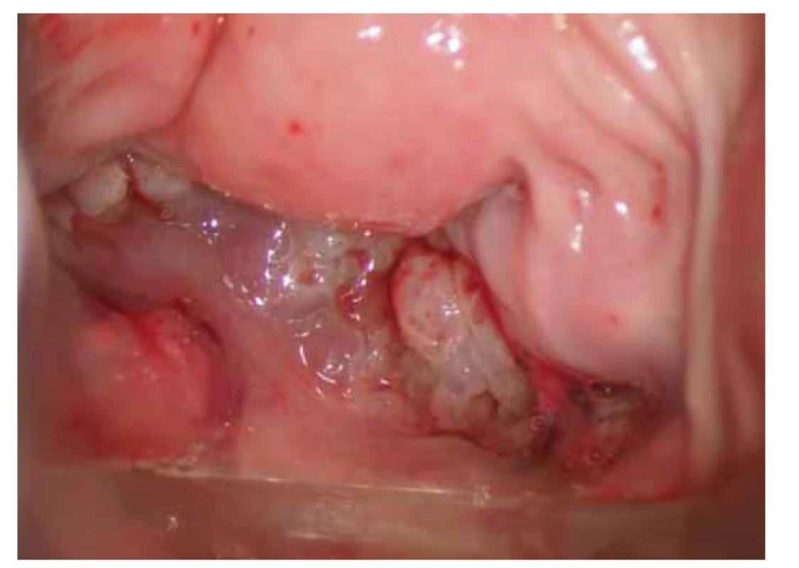 Kolposkopický obraz – 4. měsíc užívaní antituberkulotik.<br>
Fig. 4. Colposcopic examination – 4th month of antituberculosis treatment.