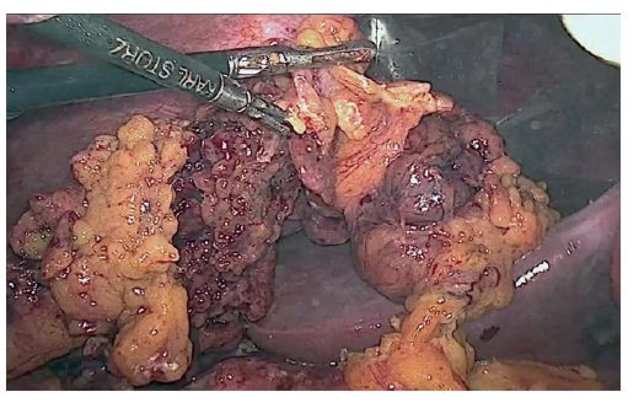 Resekát omenta<br>
Fig. 1: Omental specimen