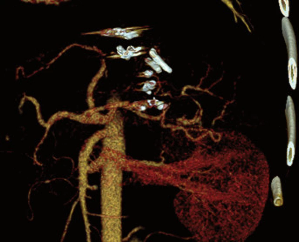 Kontrolní CT angiografie břicha. Zdroj: MUDr. Jiří
Novotný Ph.D., Pracoviště radiodiagnostiky a intervenční
radiologie, IKEM.<br>
Fig. 4. Control CT angiography of abdomen. Source:
Jiri Novotny M.D., Ph.D., Radiology and Intervention
radiology, IKEM.