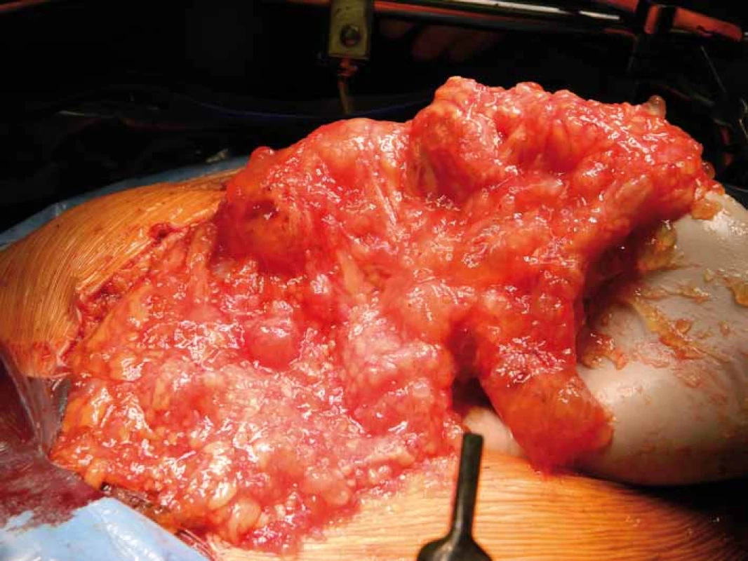 Rosolovité břicho – „jelly belly“.