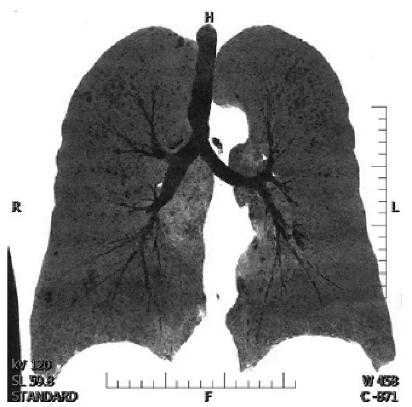 CT plic, obraz miliárního rozsevu <br> 
Fig. 1. CT lung, miliary TB