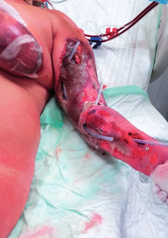Nekrotizující fasciitida horní končetiny u pacientky ze třetí kazuistiky (uveřejněno se souhlasem pacientky)<br>Figure 1. Upper limb necrotising fasciitis in patient 3 (published with the patient's consent)