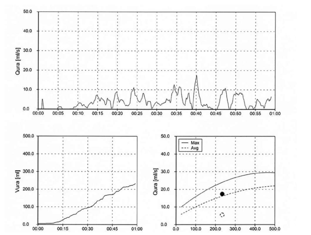 Domácí uroflowmetrie – Staccato křivka s použitím břišního lisu<br>
Fig. 4. Home uroflowmetry – Staccato curve using an abdominal press