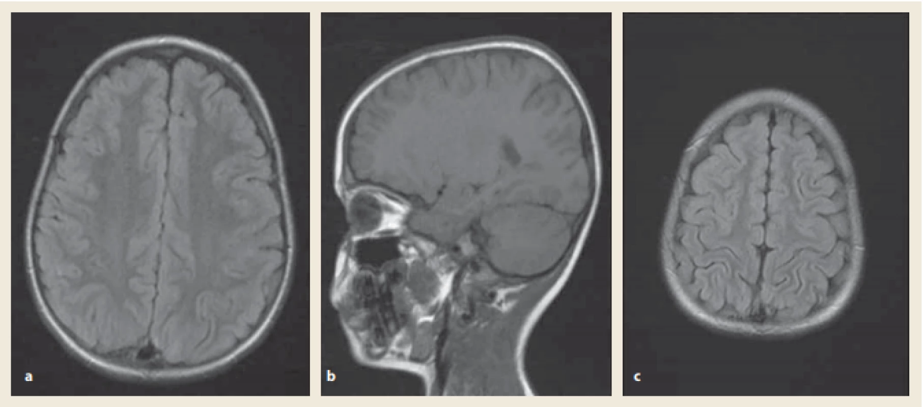 Magnetická rezonance mozku za týden po PRES.
FLAIR sekvence: normalizace nálezu. Zdroj: Radiologická klinika LF UP a FN Olomouc.<br>
Fig. 2. Brain magnetic resonance imaging one week after the PRES.
FLAIR images: resolution of previous lesions. Source: Radiological clinic LF UP and FN Olomouc.