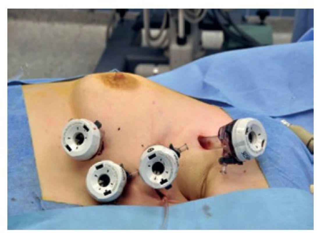 Rozmístění trokárů<br>
Fig. 10: Placement of trocars
