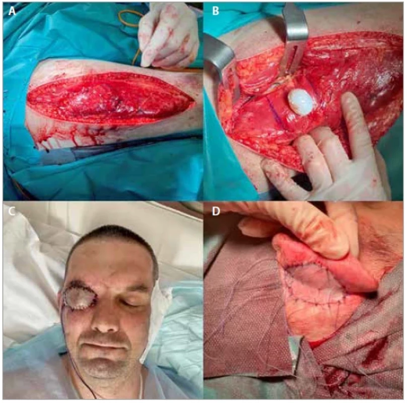 (A) Dissection of the vastus lateralis muscle flap; (B) acrylic conformer
implant; (C) coverage of the vastus lateralis muscle flap with the full-thickness
skin graft from the retroauricular area; (D) closure of the secondary defect in
the retroauricular area with the split-thickness skin graft from the contralateral
thigh.