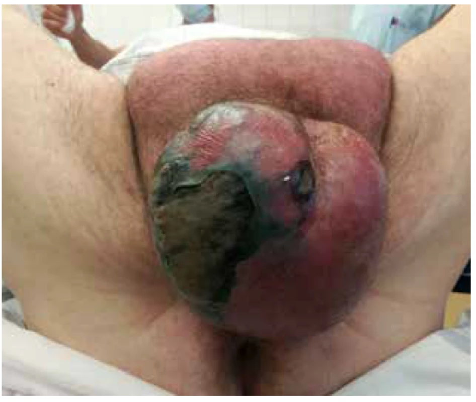 Gangréna skrota s flegmonou v podbřišku<br>
Fig. 2. Scrotal gangrene with hypogastric phlegmon
