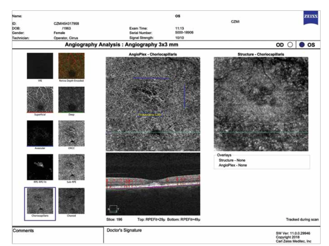 Optická koherenční tomografická angiografie stejné pacientky 1 rok po provedené redukované fotodynamické terapii (Angioplex
Zeiss Cirrus 5000, Carl Zeiss Meditec): v místě původního aktivního ložiska pod undulujícím retinálním pigmentovým epitelem
v zóně choriokapilaris je jasně zřetelná inaktivní choroidální neovaskularizace (žlutá šipka)