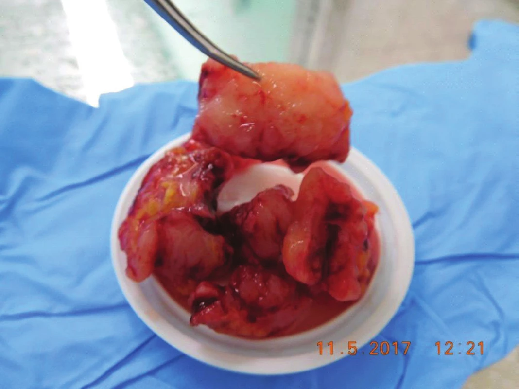 Tumor masses removed during surgery, in cut whitish,
crumbly, with no case