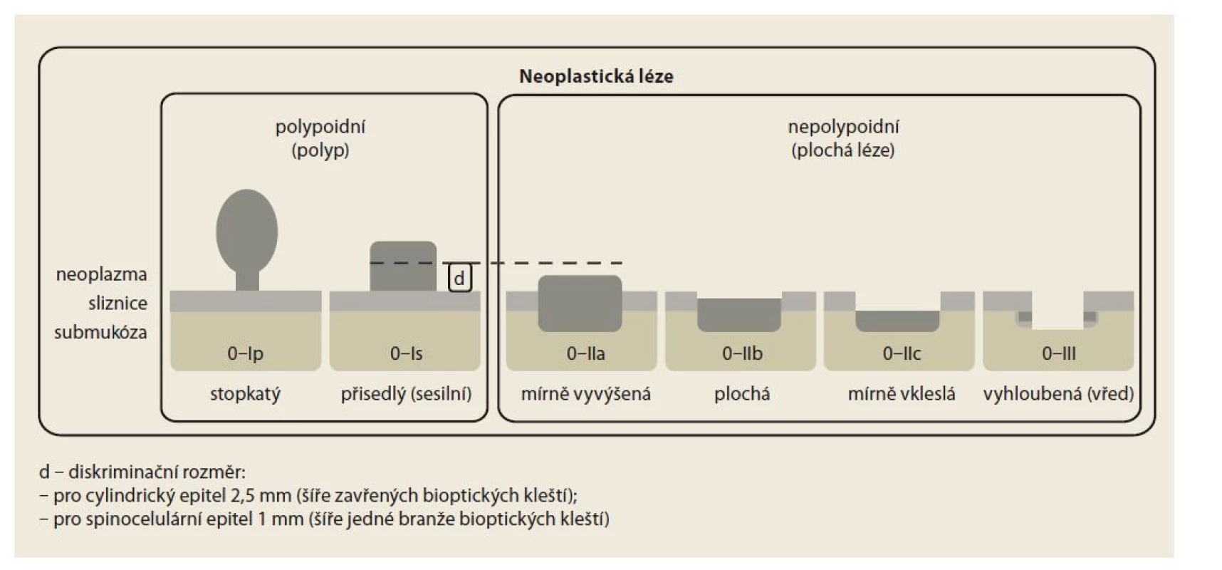 Schéma Pařížské klasifikace.<br>
Fig. 2. Paris classification scheme.