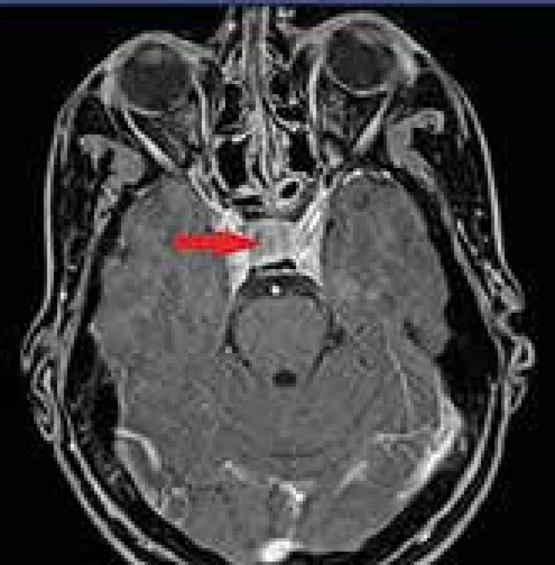 Pooperačné MRI vyšetrenie (axiálny rez)
s nálezom rezidua makroadenómu hypofýzy
veľkosti 14 × 14 × 7 mm