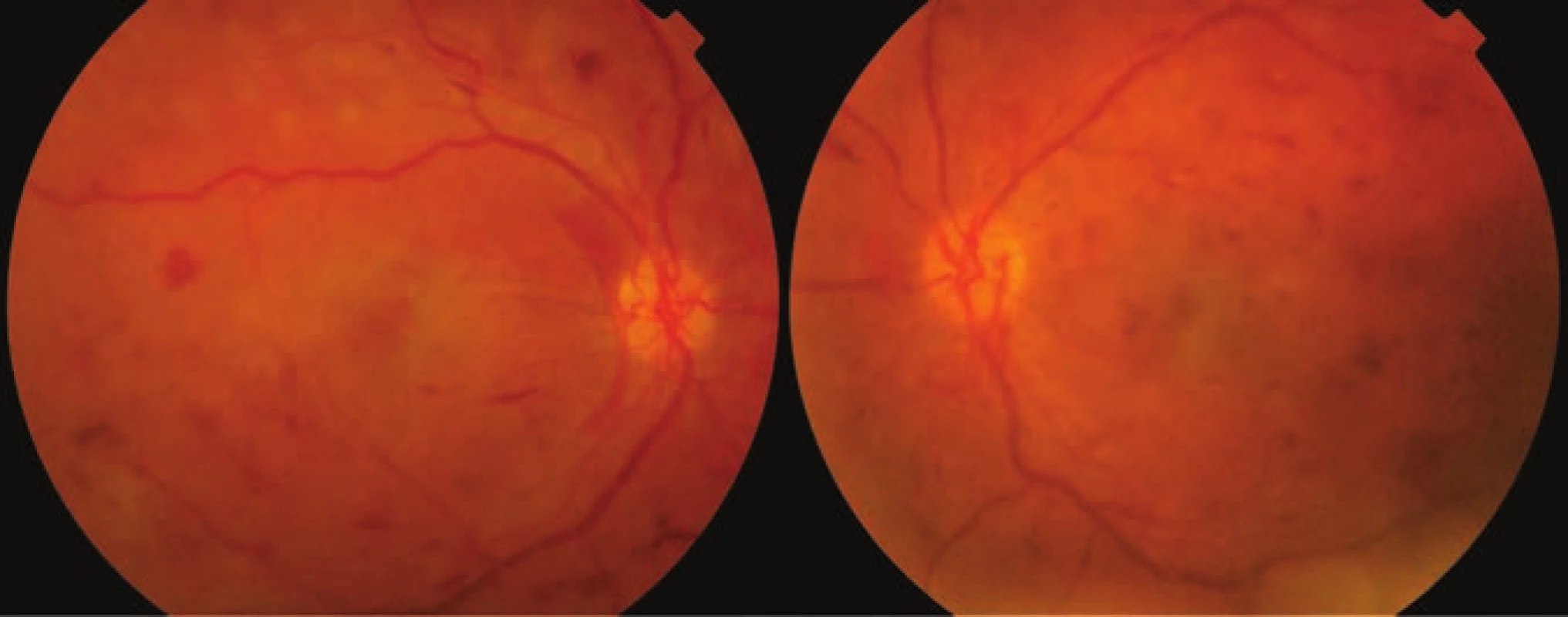Photograph of ocular fundus of both eyes in 23rd week of second pregnancy
