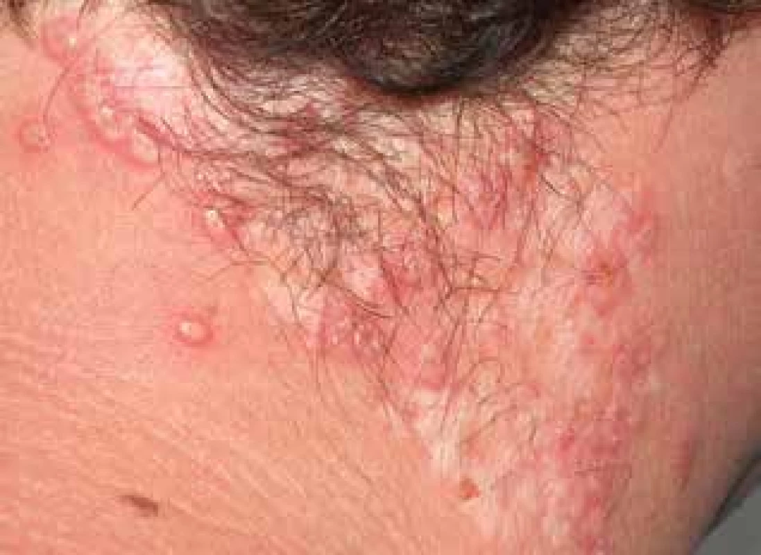 Lupus miliaris disseminatus faciei