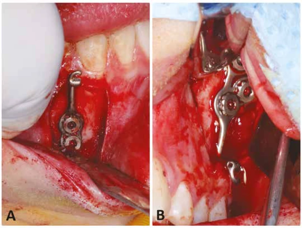 Perioperační intraorální
fotografie zavádění
skeletálních miniplatů typu
Bollard –
(A) pravá dolní dlaha;
(B) levá horní dlaha<br>
Fig. 2
Per operative intraoral
picture of the Bollard
skeletal miniplates insertion –
(A) lower right plate;
(B) upper left plate