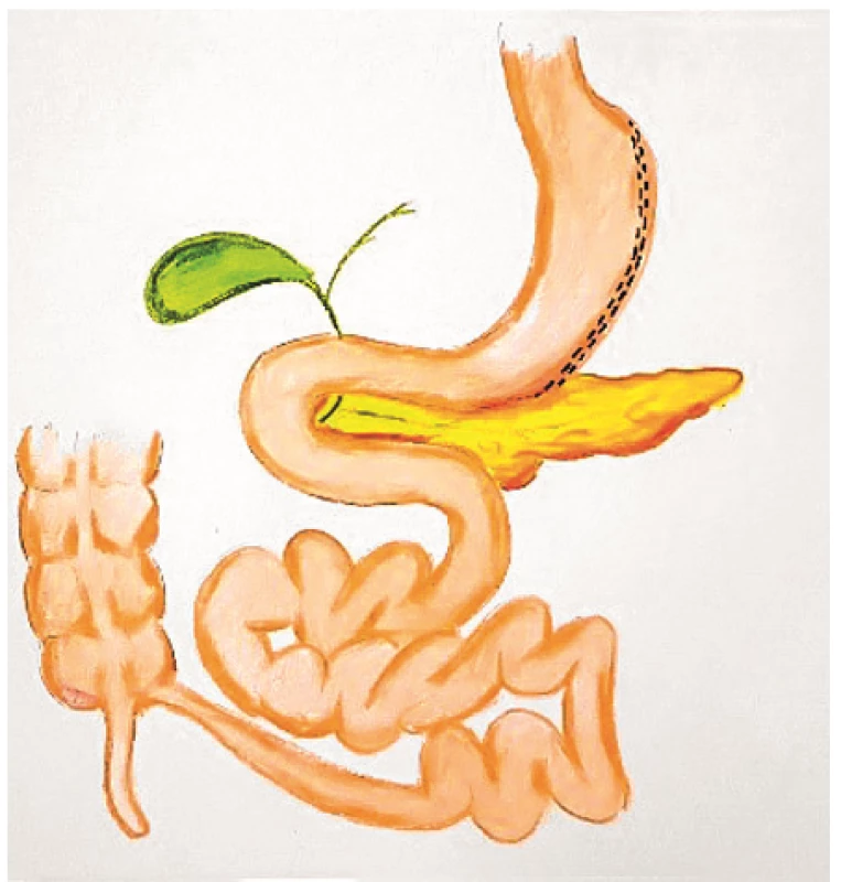 Sleeve gastrektomie