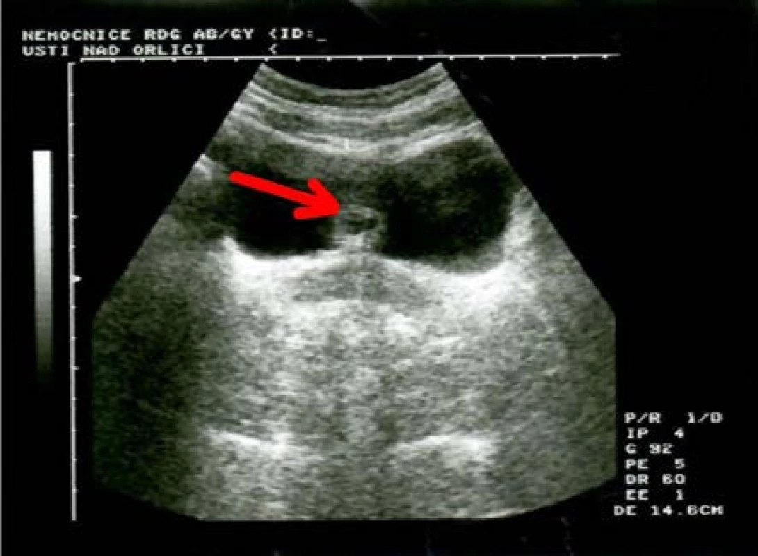 Ultrazvuk – anechogenní cystický útvar na
zadní stěně močového měchýře<br>
Fig. 1. Ultrasound – anechoic cystic form on the
bladder back wall