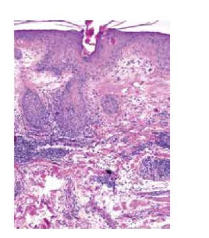 a. Histopatologické vyšetření s folikulárně akcentovanou
hyperkeratózou, výrazným zesílením bazální membrány
epidermis a denzními lymfocytárními perivaskulárními
a periadnexálními infiltráty (HE, 100x)
