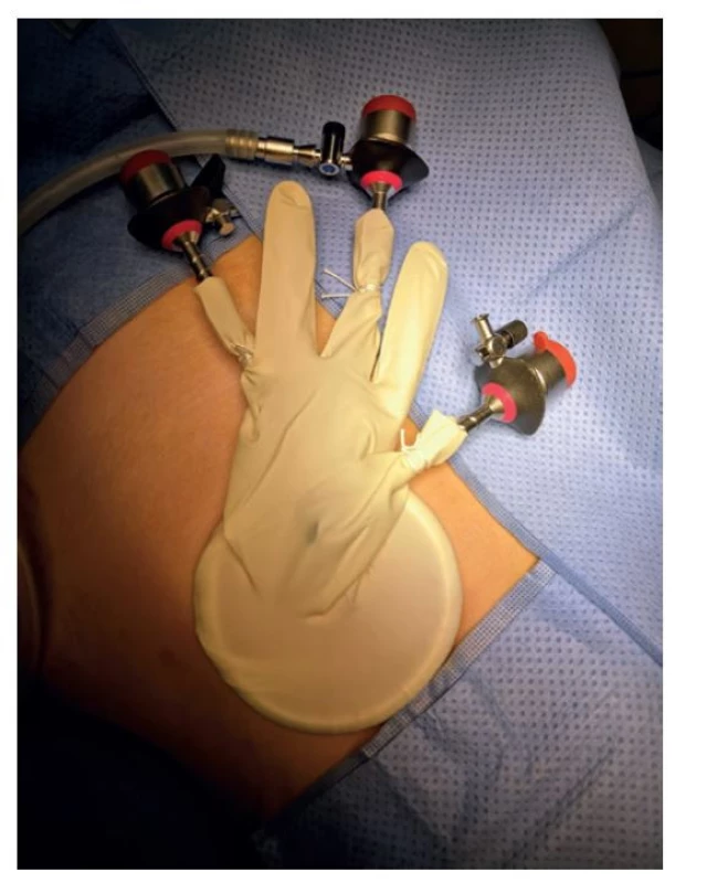 Standardní 5 mm laparoskopické porty fixované
v prstech rukavice<br>
Fig. 3: Standard 5 mm laparoscopic ports fixed in the fingers
of the glove