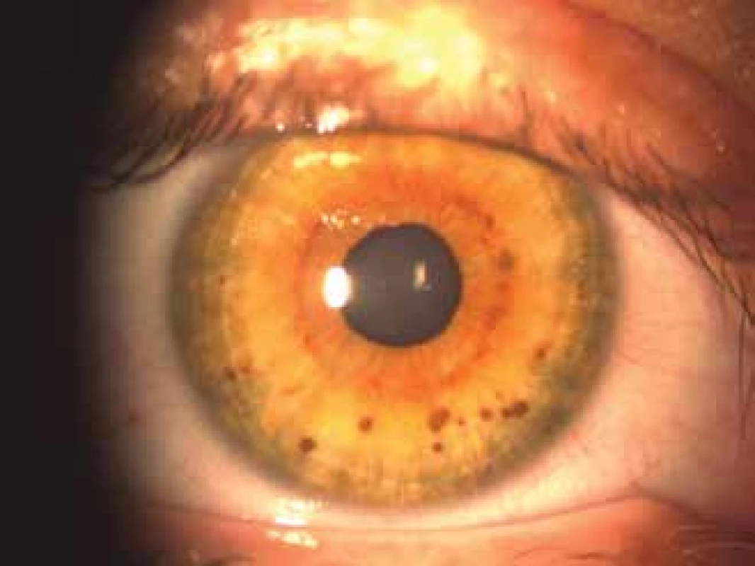 Lisch nodules<br>
Source: Children’s Ophthalmology Clinic, Faculty of Medicine,
Masaryk University and University Hospital Brno