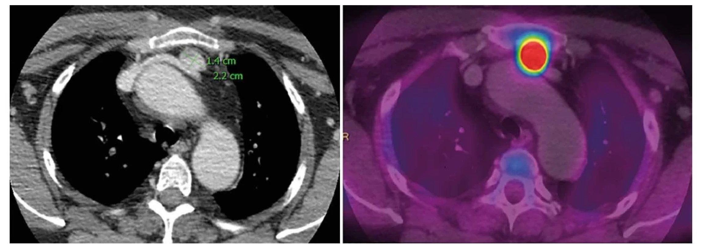 PET/CT, adenom příštítného tělíska ve tkáni thymu<br>
Fig. 2: PET/CT, parathyroid adenoma in thymic tissue