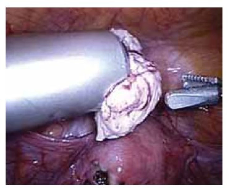 Laparoskopická morcelace
myomu.<br>
Fig. 2. Laparoscopic morcellation
of myoma.