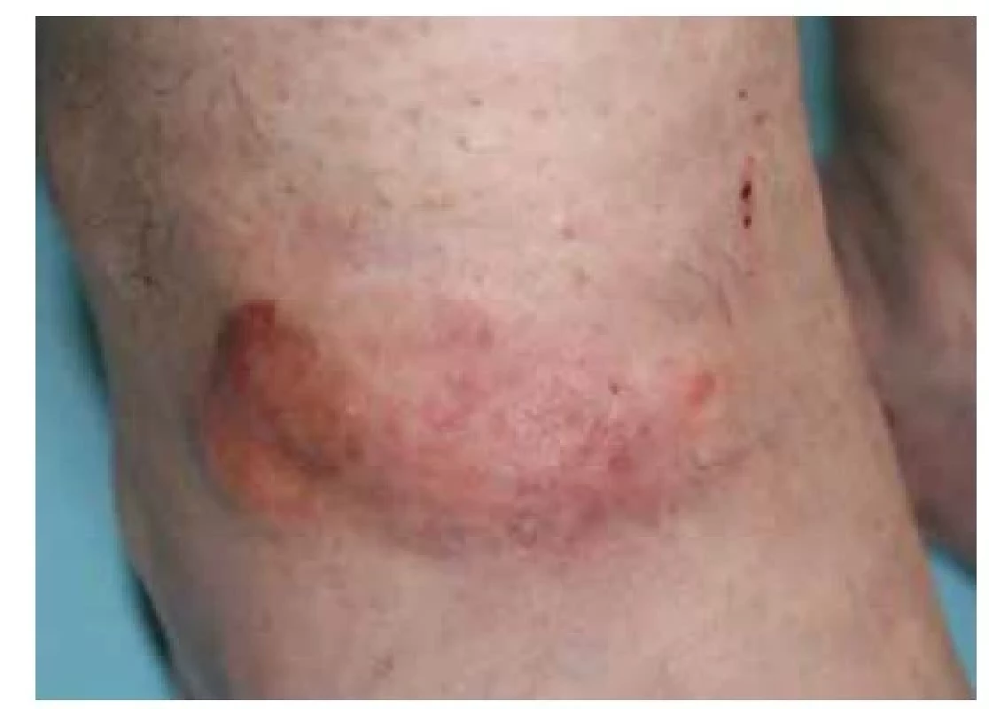 Nodulární amyloidóza – klinický obraz
