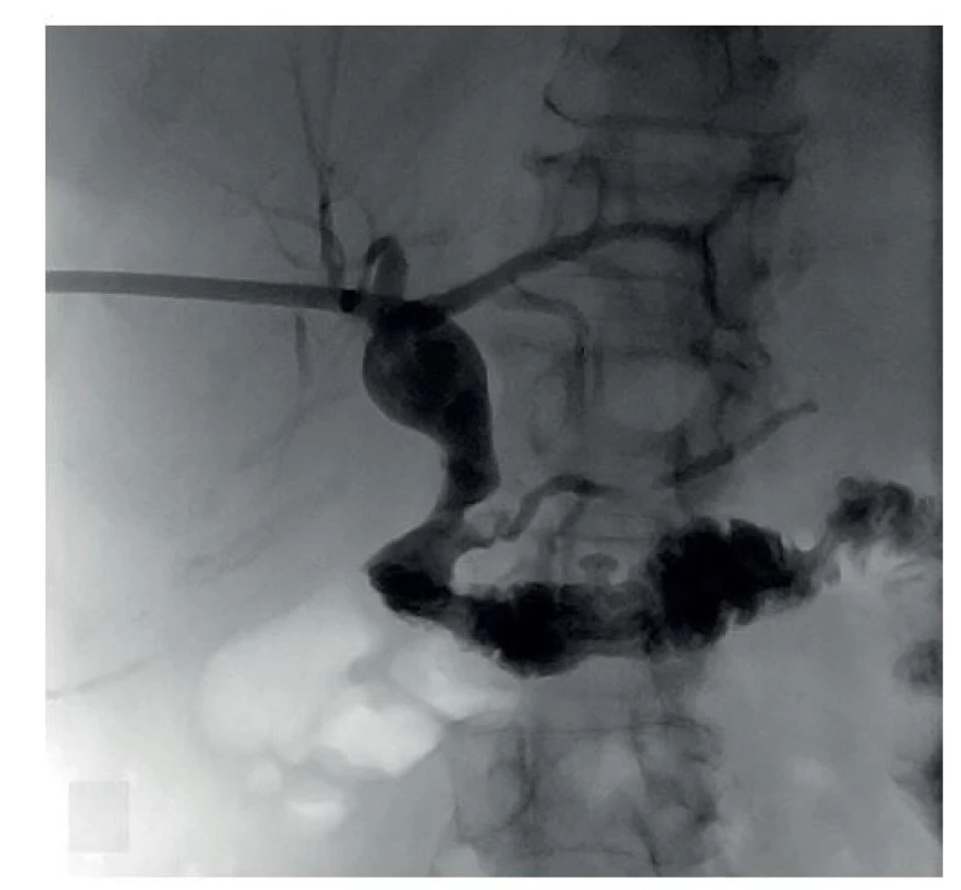 PTC po ileocekální resekci a odstranění příčiny nekompletní
obstrukce tenkého střeva<br>
Fig. 4: PTC after ileocecal resection and elimination of the
cause of incomplete obstruction of the small intestine
