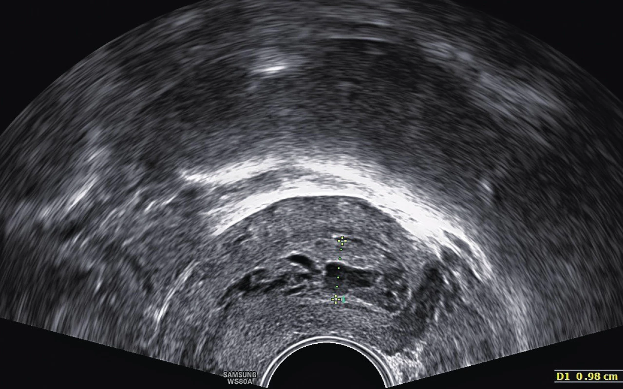 Degenerativně změněný polyp bez patologické vaskularizace – nesuspektní 