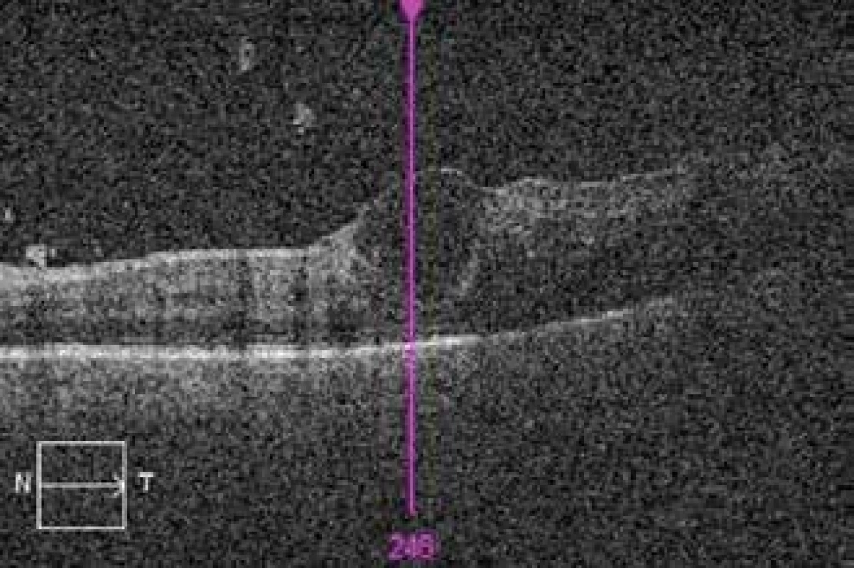 OCT of left eye 2 weeks after commencement of
therapy, inflammatory changes in vitreous body, macrocyst
in region of foveal depression