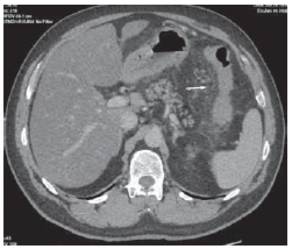 Prosáknutí a zesílení kořene
mezenteria v oblasti lienální flexury. <br> 
Fig. 3. Permeation and strengthening
of the root of the mesentery in the area
of the lienal flexure.