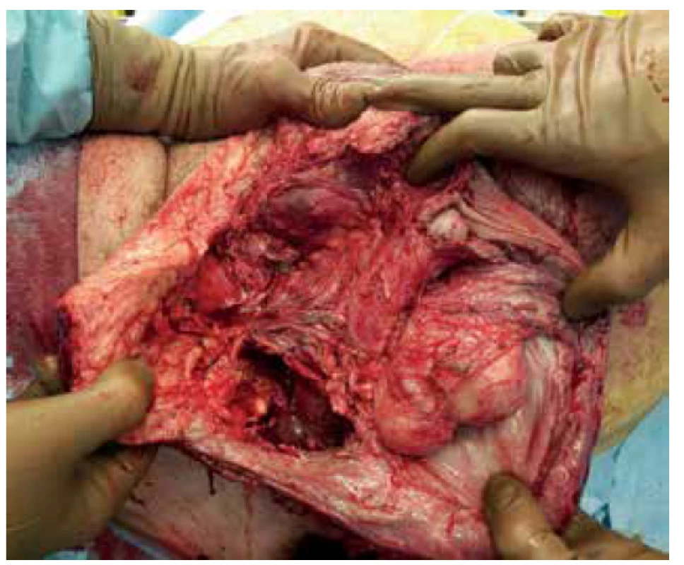 Stav po nekrektomii<br>
Fig. 4. Condition after necrectomy