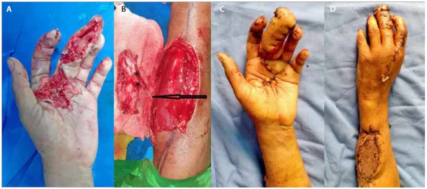 (A) Defect over the middle finger, over the distal and the middle phalanx, the recipient vessels have been
dissected; (B) flap harvested from the forearm with the attached pedicle; (C) post-operative picture one week
after flap inset; (D) post-operative picture one week after flap inset, donor site. K-wire for immobilisation of the
metacarpophalangeal joint, the dorsal digital vein was dissected from the index finger.