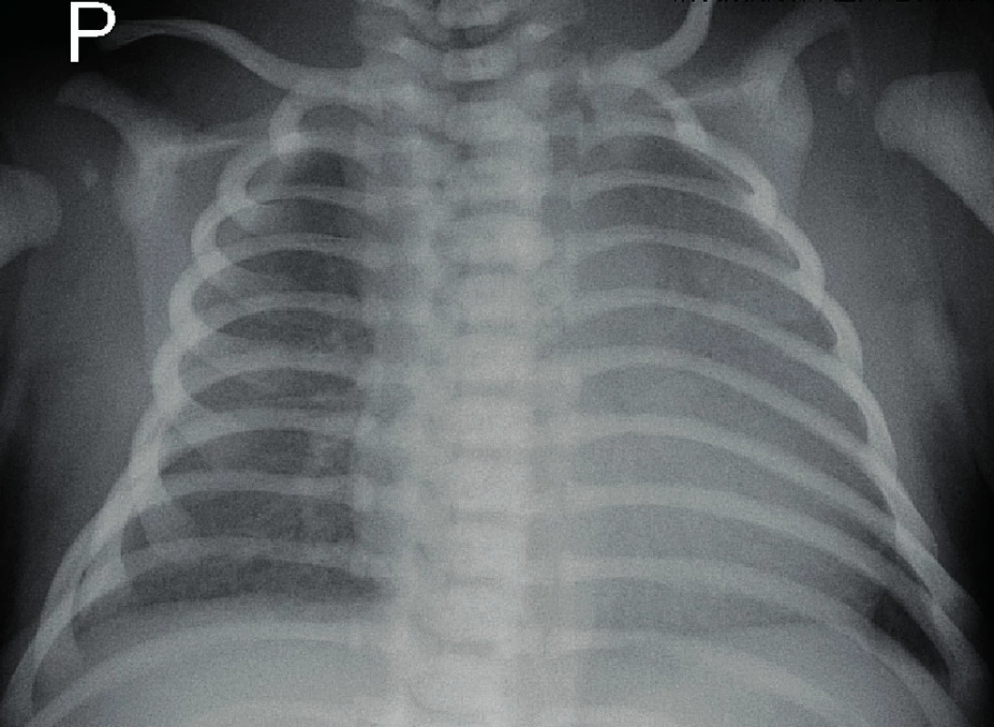Rentgen hrudníku – zastření levého středního plicního
pole při aspiraci plodové vody.<br>
Fig. 1. X-ray of the chest – diffuse haziness of the left middle
lung field.