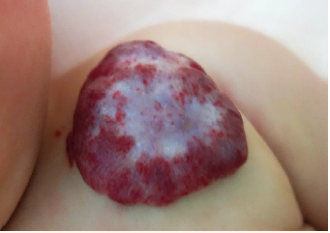 IH u osmiměsíčního kojence s významnými involučními změnami, mimo indikační období pro terapii propranololem.<br>
IH in 8-months old infant with significant marks of involution, too old for the propranolol treatment.