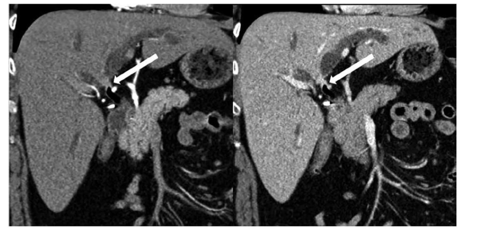 Krátká cirkulární stenóza oblasti junkce pravého a levého dc. hepaticus typu Bismuth II, výpočetní tomografie
rekonstrukce v rovině porta hepatis, vlevo arteriální fáze, vpravo portální fáze<br>
Fig. 1: Short circular stenosis of right and left dc. hepaticus junction area type Bismuth II, computed tomography
reconstruction in the plane of porta hepatis, left: arterial phase, right: portal phase