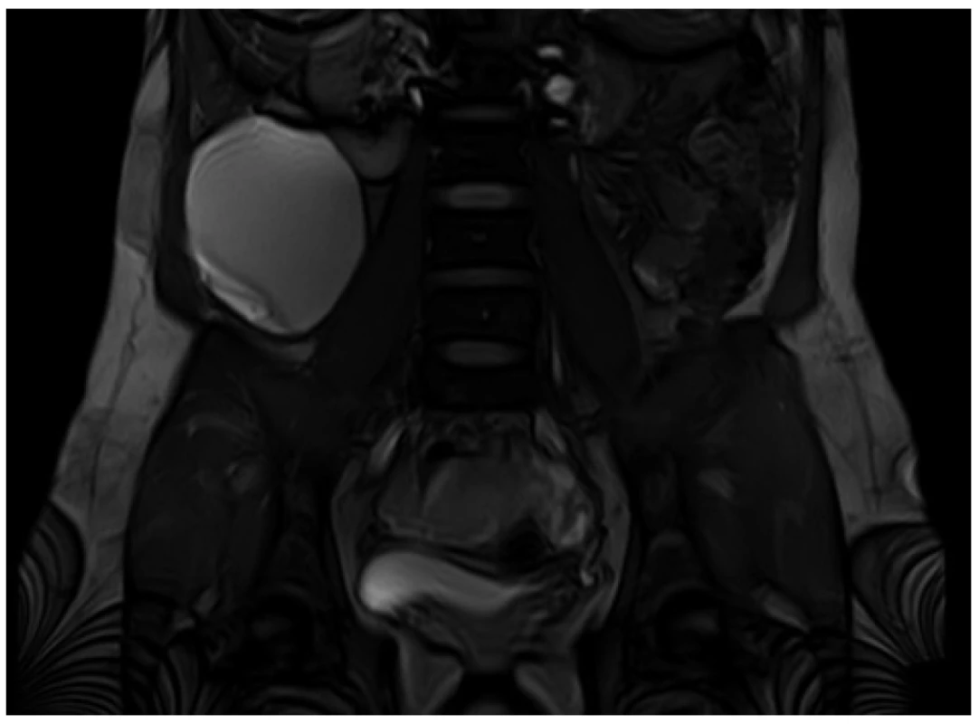 MRI břicha, koronární řez <br>
Jedna z porcí cystické expanze v intimním vztahu k pravé ledvině. <br>
Fig. 3: Abdominal MRI, coronary view <br>
Part of the cystic expansion in close relationship with the right kidney.