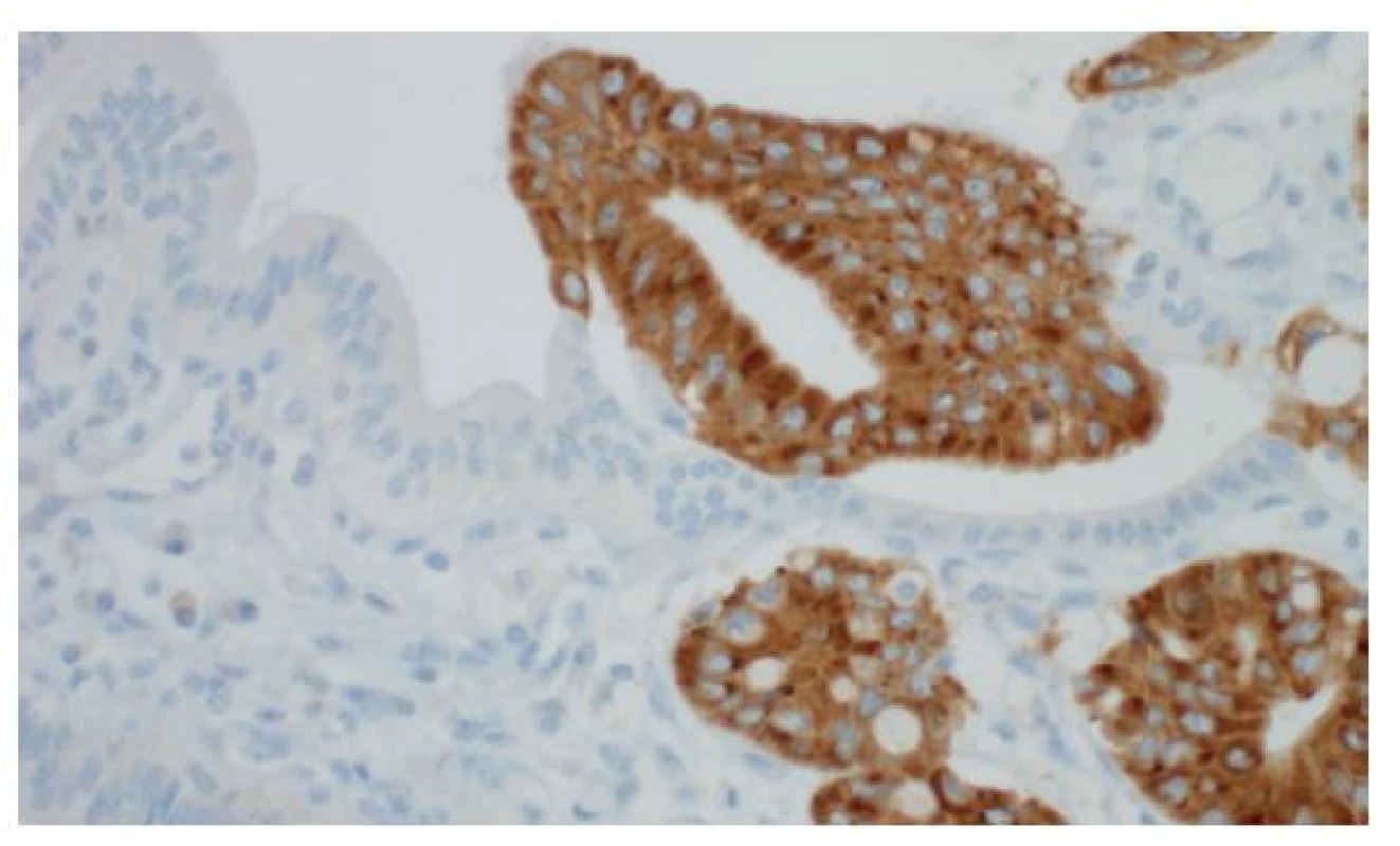 Imunohistochemická pozitivita insulin-like messenger
RNA binding protein 3 (IMP3) v těžké biliární
dysplazii (vpravo), normální epitel (vlevo) je negativní,
imunohistochemie, 400×<br>
Fig. 7: Positive finding of the insulin-like messenger RNA
binding protein 3 (IMP3) based on immunohistochemistry
in a high-grade biliary dysplasia (on the right); negative
finding in the non-neoplastic epithelium (on the left);
immunohistochemistry, 400×