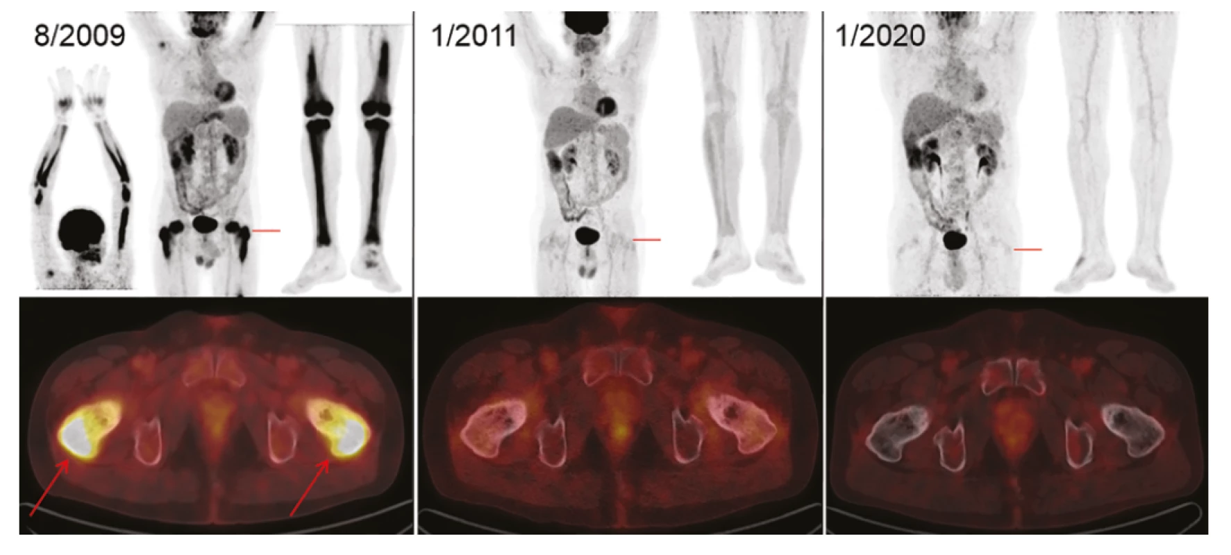 Zobrazení nemoci pomocí FDG-PET/CT vyšetření: Vlevo iniciální sken s MIP projekcí trupu, horních i dolních končetin (v černobílé barevné škále).
Červeně označené místo axiálního fúzovaného řezu (v barevné škále Hot Body) s maximem FDG-avidního postižení proximálních stehenních kostí (šipky)
v korelaci se skleroticko-lytickou strukturou kosti. Uprostřed obraz svědčící pro remisi – vymizení patologických akumulací FDG ve skeletu horních i dolních
končetin. Tento stav trvá i po 9 letech, což dokumentují identické obrázky vpravo. Akumulace FDG v mozku, ledvinách, močovém měchýři je fyziologická.
Akumulace v myokardu, ve vzestupném tračníku v rámci variant fyziologického zobrazení