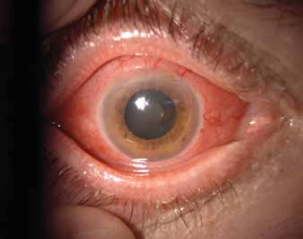 Sclerouveitis